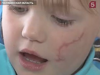 Видеоновость: Девочке, чье лицо изуродовали бродячие собаки, помогут челябинские врачи
